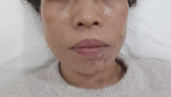 After face treatment malta spots acne