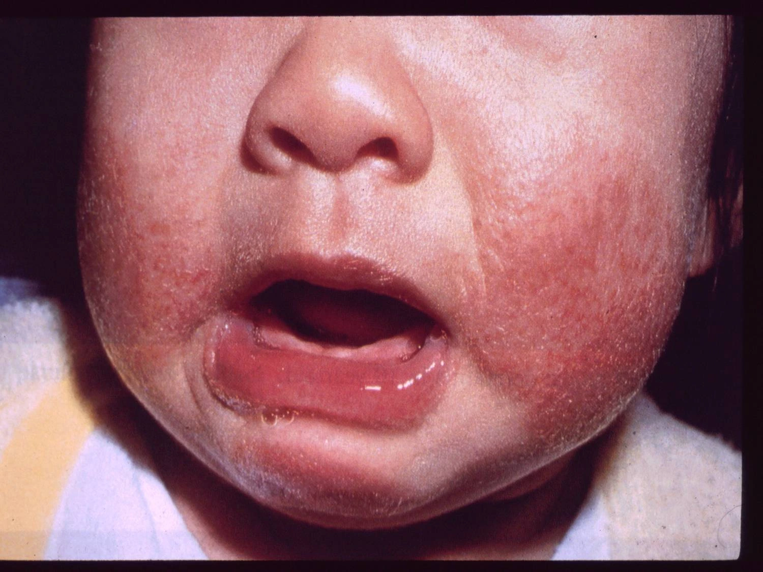 baby eczema on face