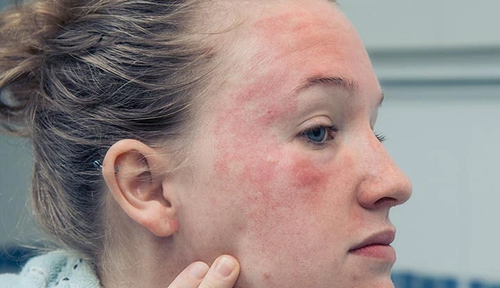 eczema on face malta