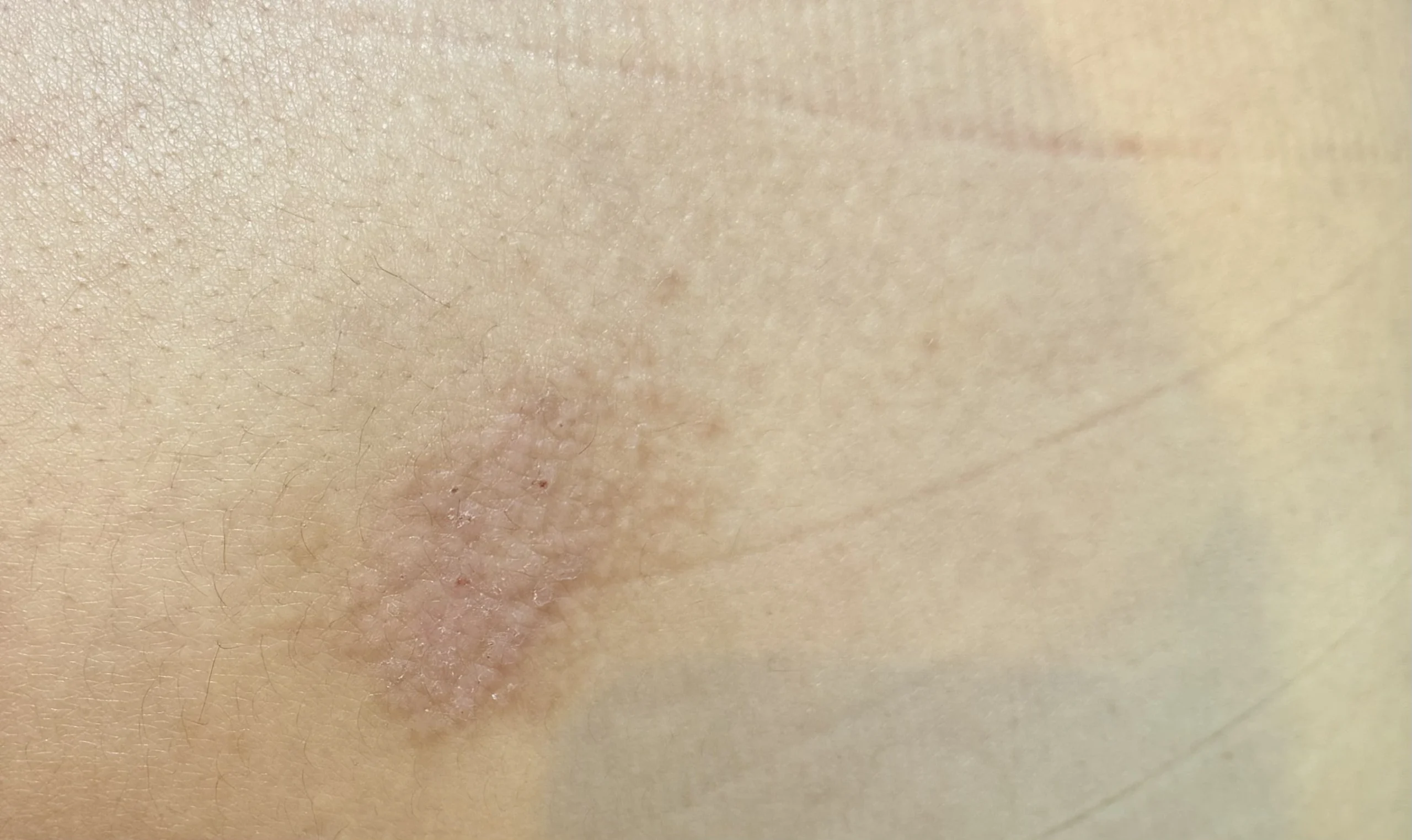 ezcema treatment malta noon clinic