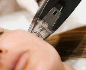 Lifting-facial microneedling malta