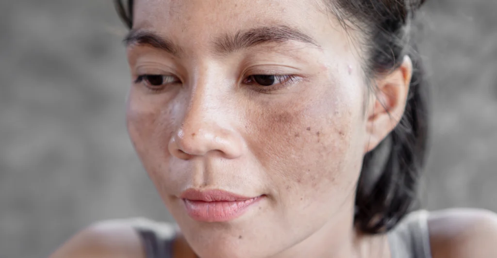 Advanced hyperpigmentation treatment at BDR Clinic Malta in Birkirkara