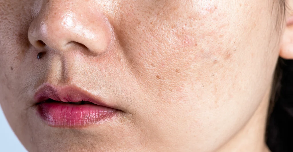 Melasma treatment in Malta helping reduce facial pigmentation and uneven skin tone