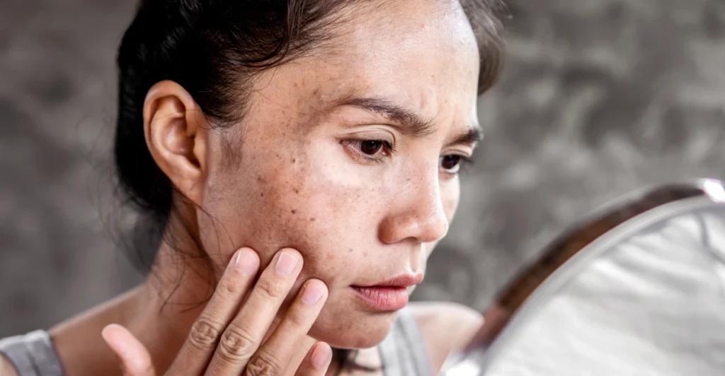 Early signs of sun damage and photoaging on facial skin in Malta