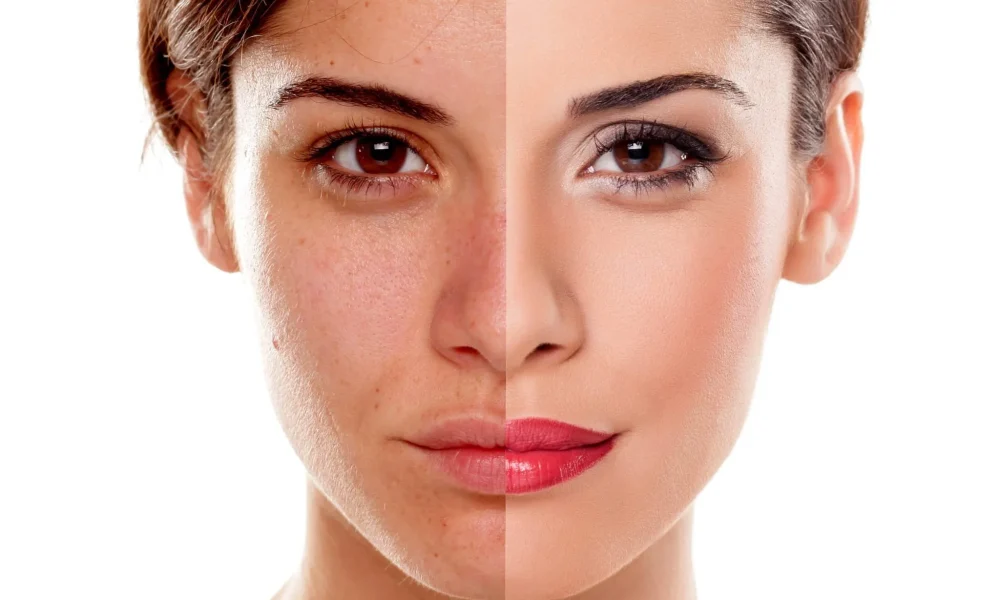 Chemical-Peel facial care Malta