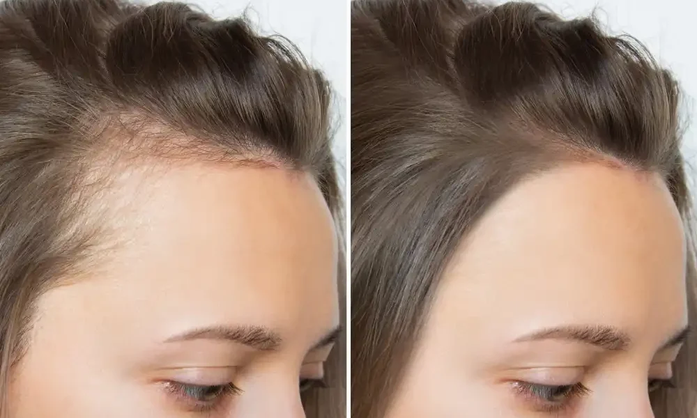 mesotherapy Hair Regrowth women malta