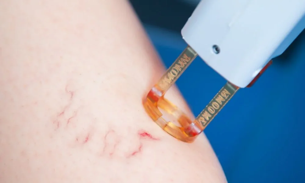 Vascular Laser malta BDR clinic