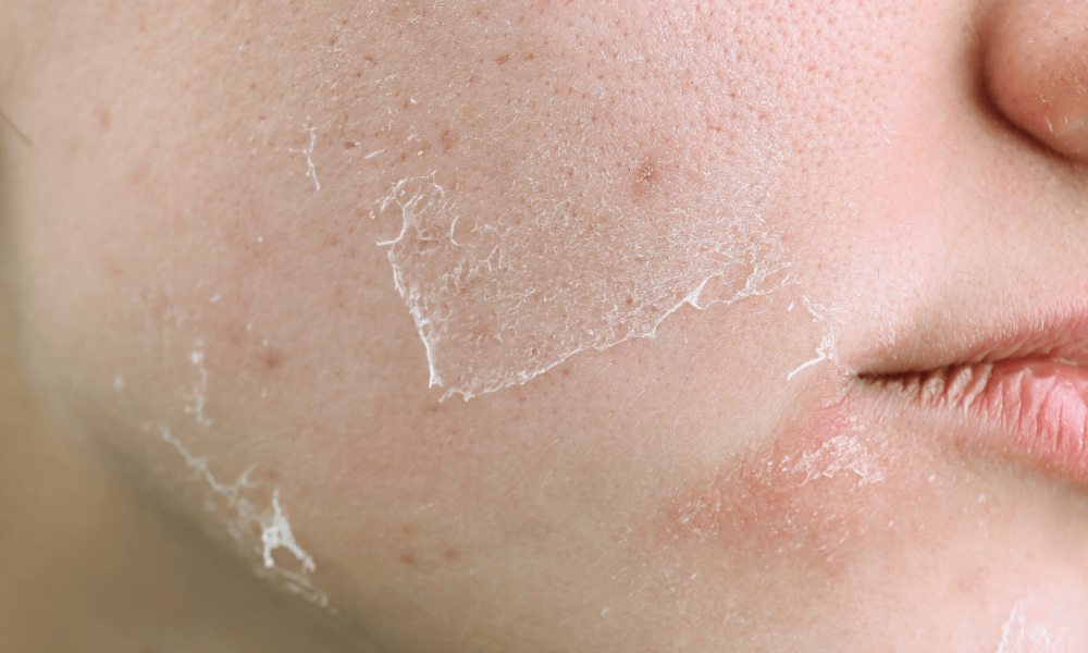 peel facial treatment BDR clinic Malta